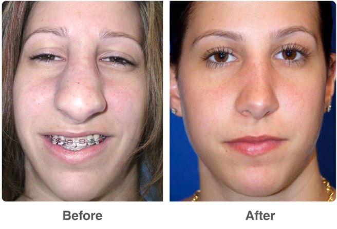 What to Expect When Getting a Nose Job.jpg